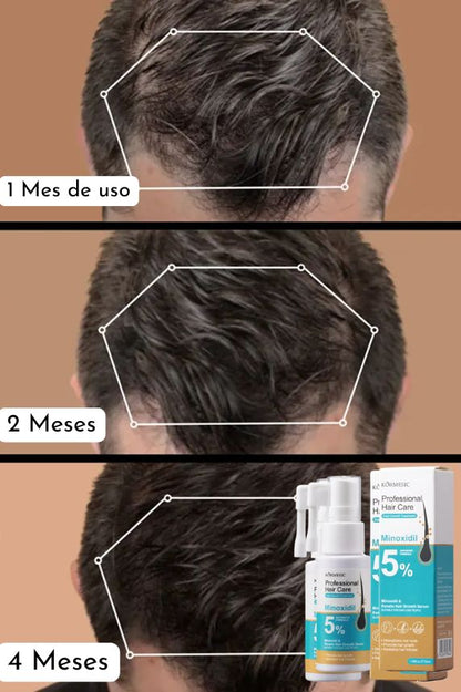 MINOXIDIL 5% ORIGINAL + CRECIMIENTO DE NUEVO CABELLO Y DETIENE LA CAIDA+ ENVÍO GRATIS🎁